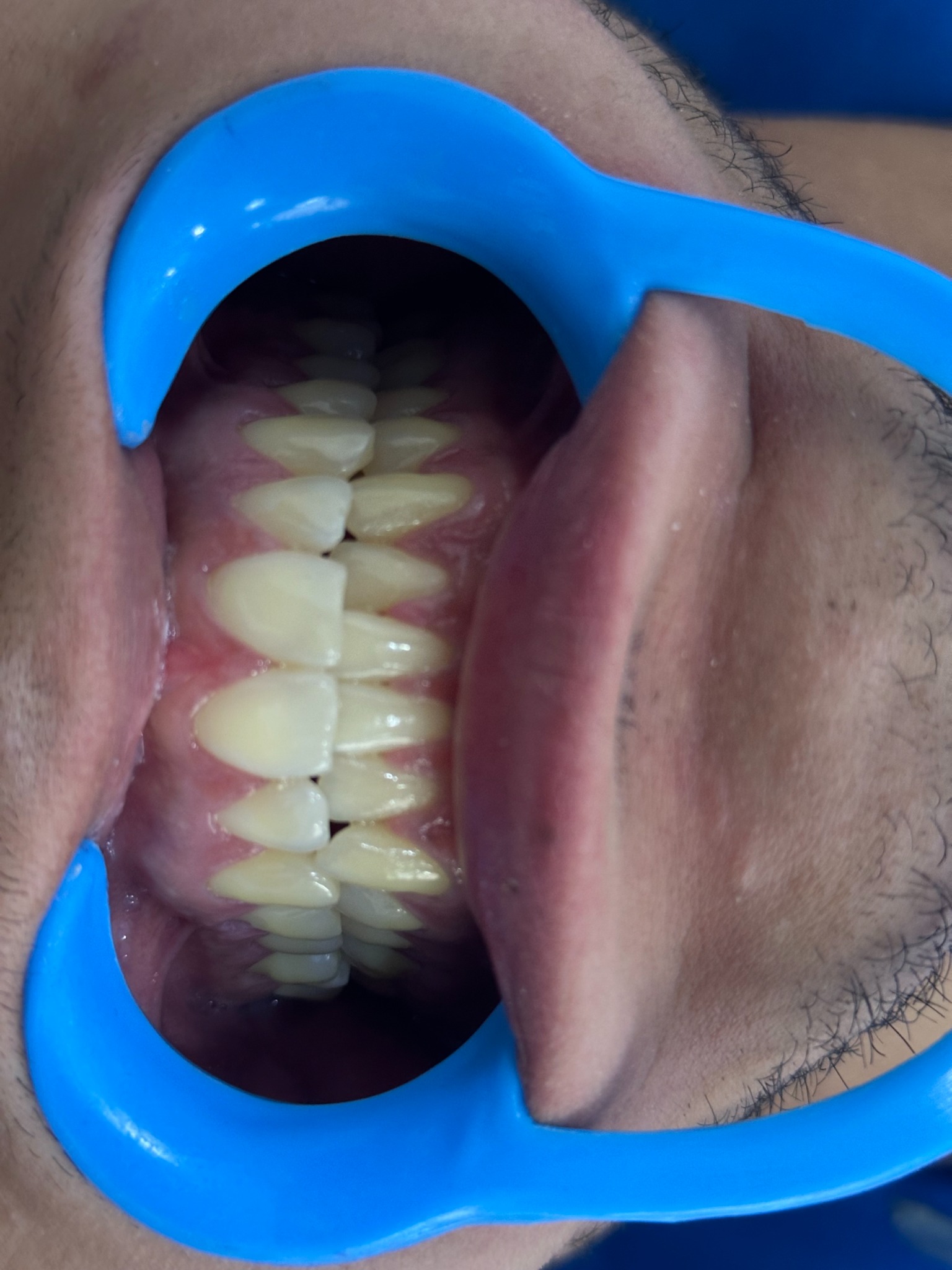 Antes de blanqueamiento dental, caso real