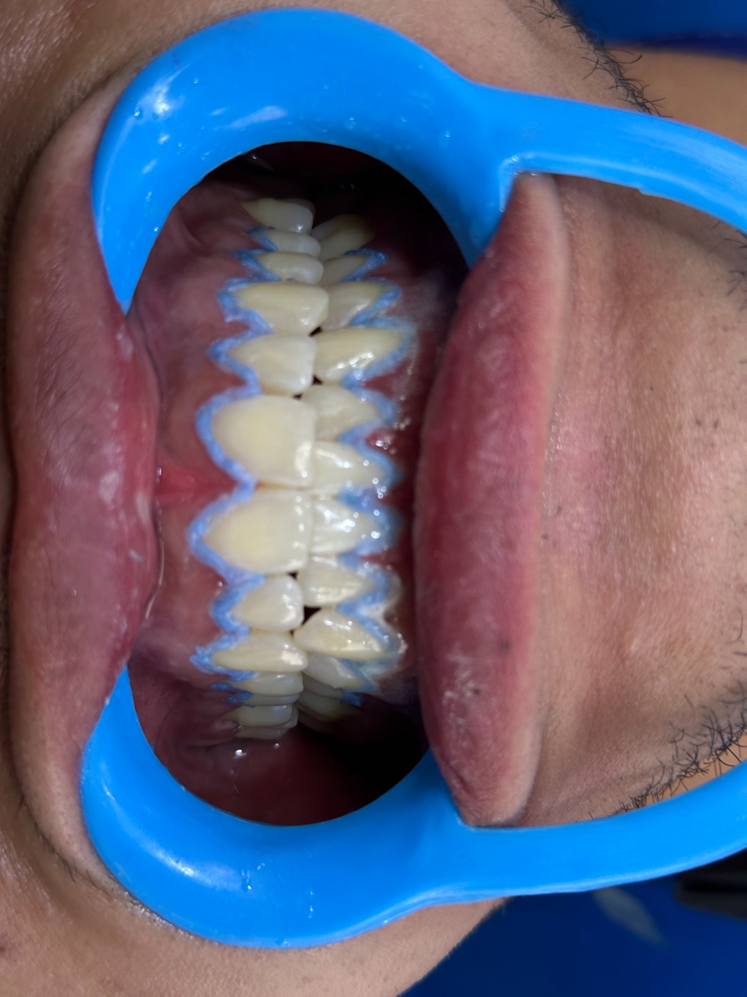 Después de blanqueamiento dental, caso real