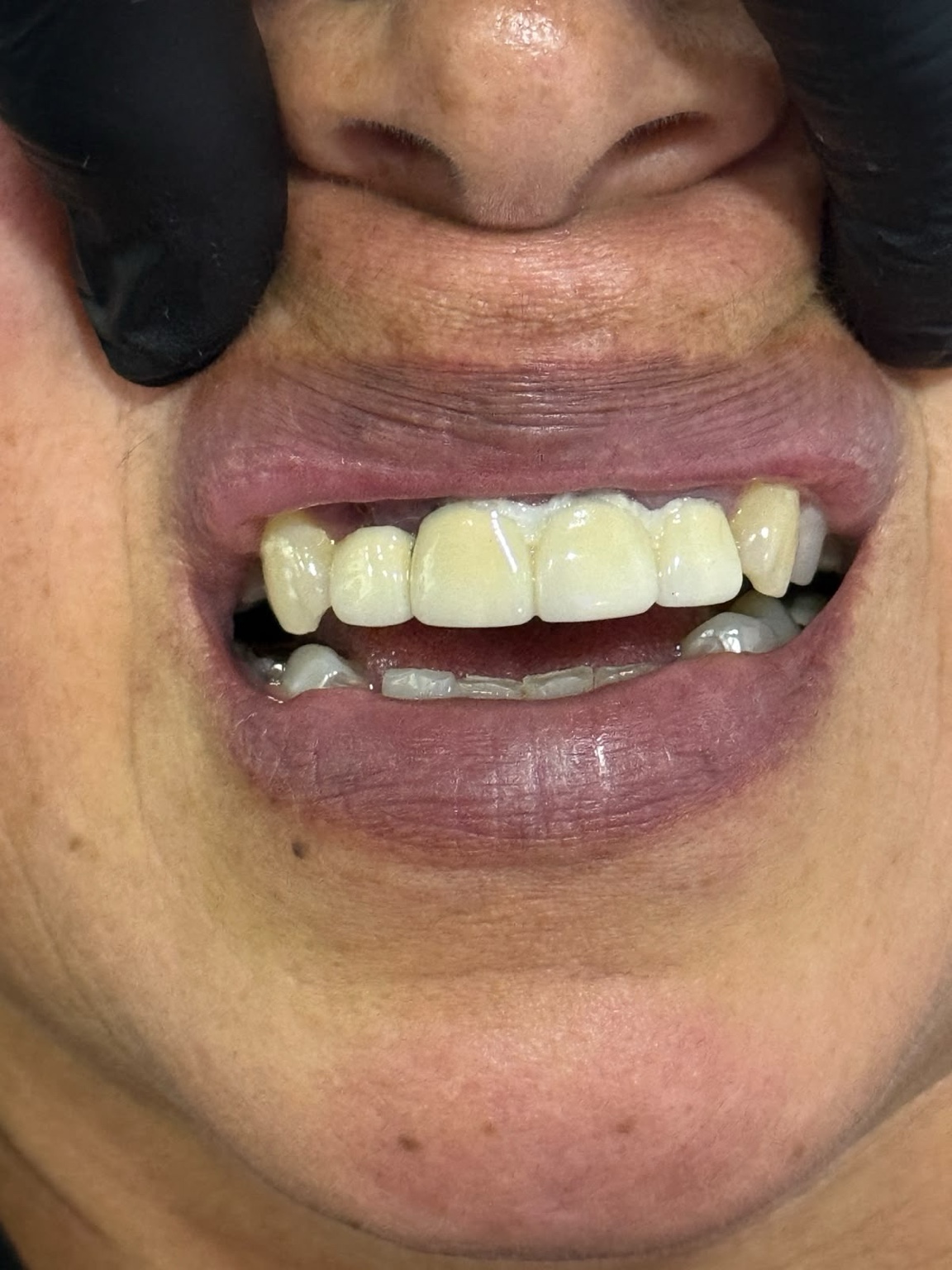 Antes de prótesis dental, caso real