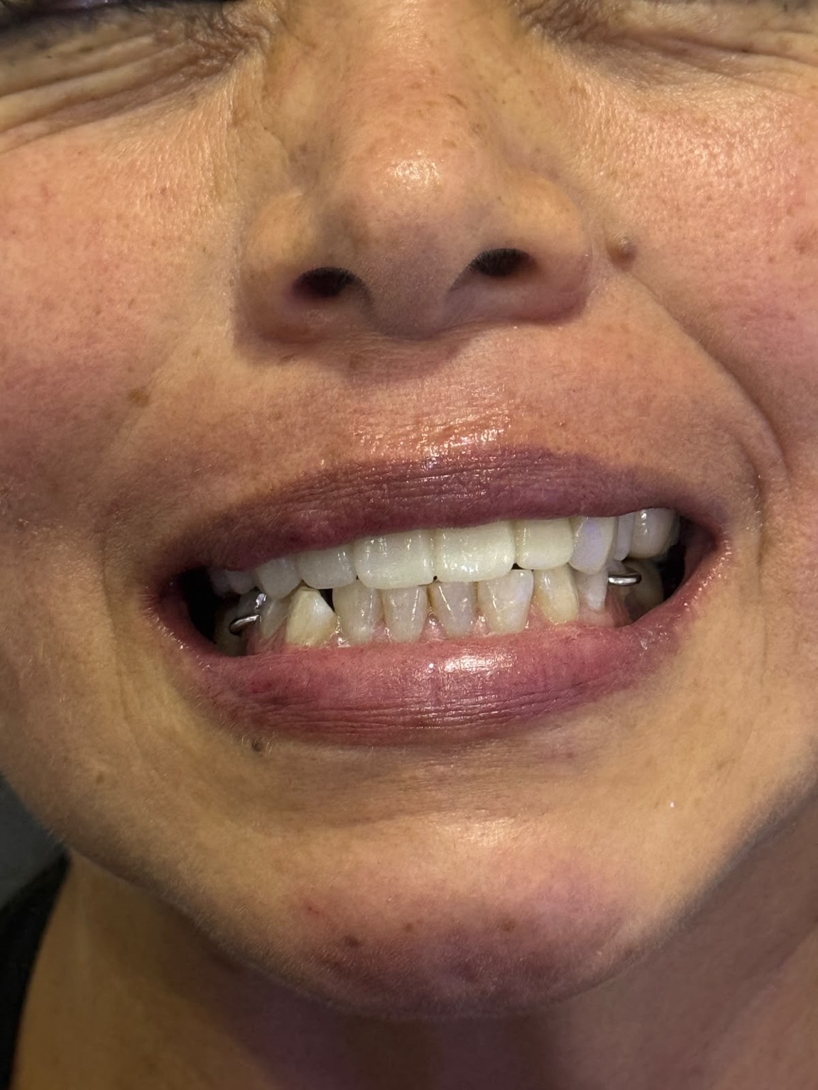 Después de prótesis dental, caso real