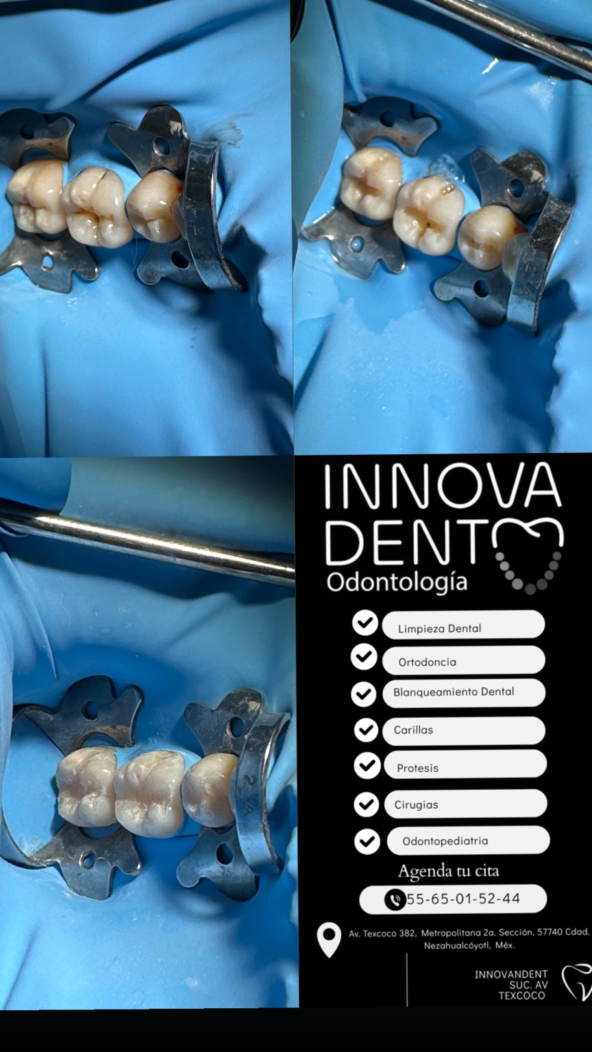 Caso clínico real de resinas dentales en Innovadent